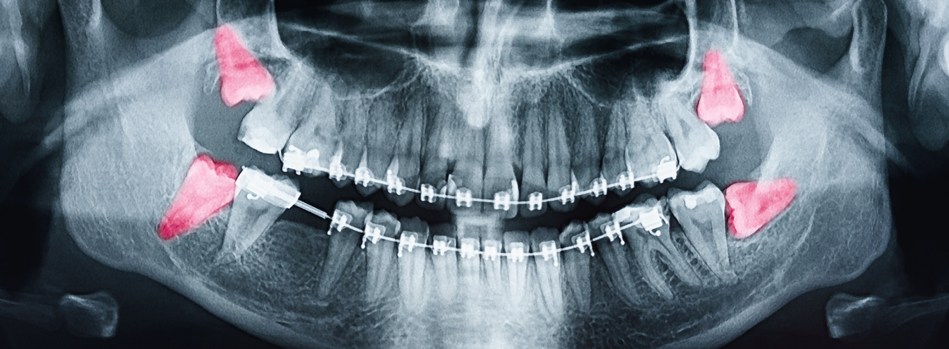 Dental Implants North Andover